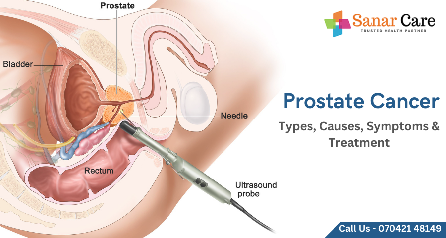 Prostate Cancer | Types, Causes, Symptoms & Treatment 
