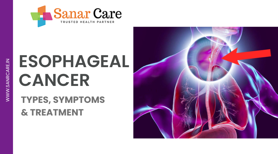 Esophageal Cancer | Types, Symptoms & Treatment 